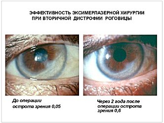 Эффективность эксимерлазерной хирургии при вторичной дистрофии роговицы