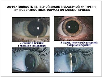 Эффективность лечебной эксимерлазерной хирургии при поверхностных формах офтальмогерпеса