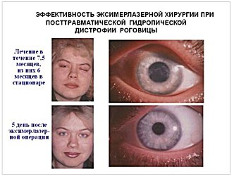 Эффективность эксимерлазерной хирургии при посттравматической гидропической дистрофии роговицы