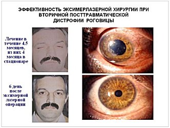 Эффективность эксимерлазерной хирургии при вторичной посттравматической дистрофии роговицы