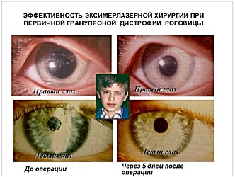 Эффективность эксимерлазерной хирургии при первичной гранулярной дистрофии роговицы