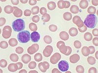 Ученые выявили маркер рака крови