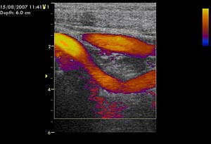 Дуплексное сканирование сонных артерий