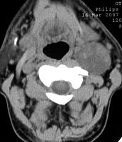 Компьютерная томография мягких тканей шеи