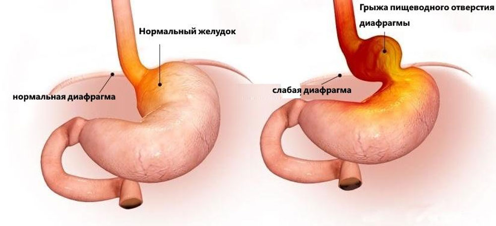 Рис. 2. Сравнительная схема нормальной анатомии в области пищеводного отверстия диафрагмы (слева) и смещения части желудка в грудную полость при ГПОД (справа)