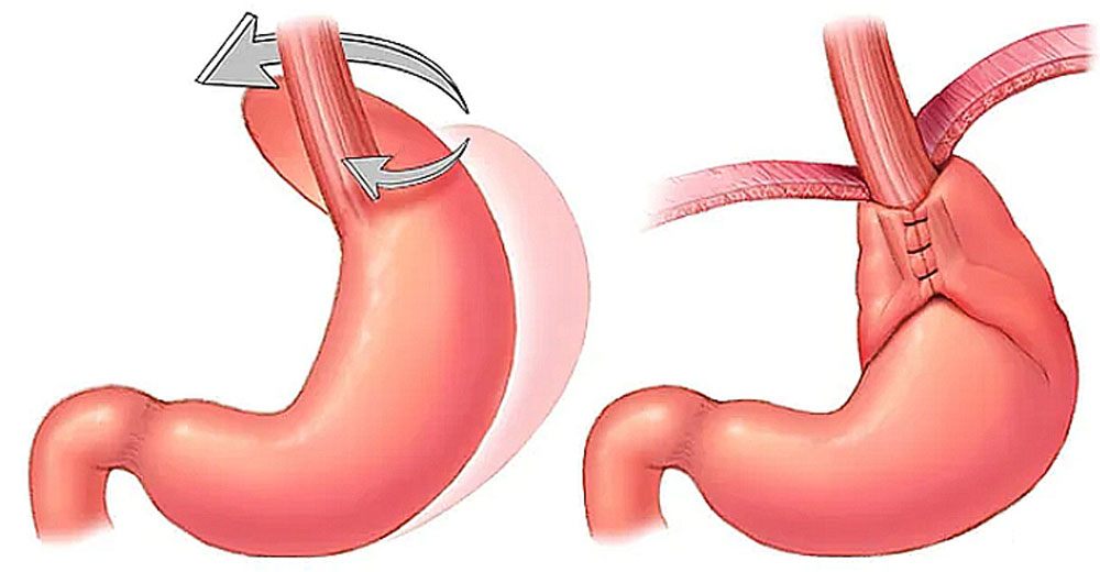 Рис. 4. Схематичное изображение фундопликации по Ниссену