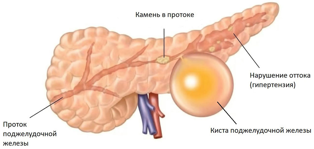 Рис. 2. Схематичное изображение кисты поджелудочной железы