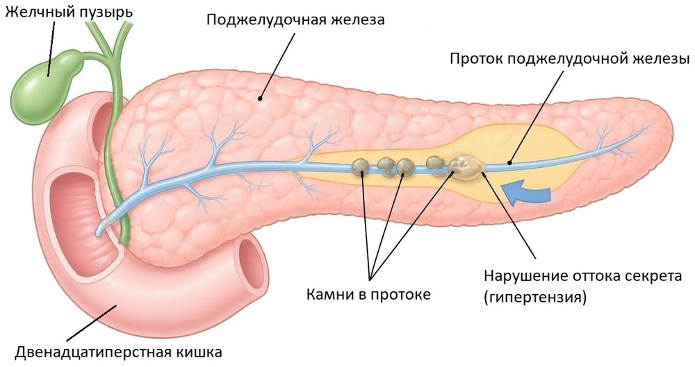 Рис. 3. Схематичное изображение вирсунголитиаза