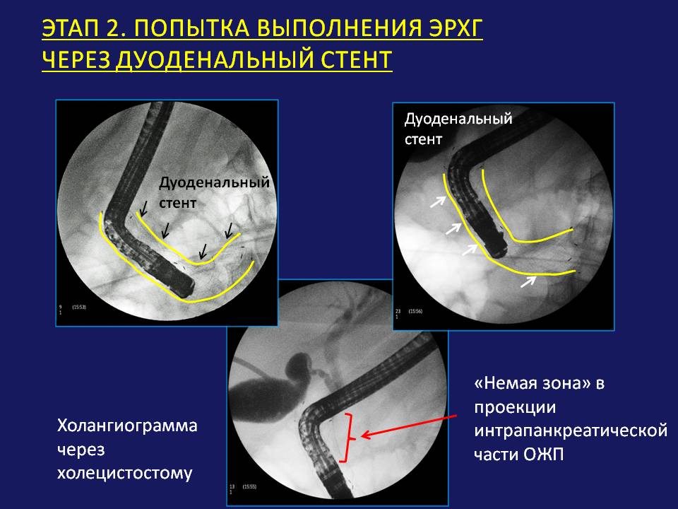 Стент желчного протока