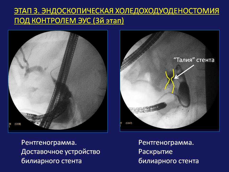 Эус желудка. Холедоходуоденостомия. Холедоходуоденоанастомоз по Финстереру. Эндоскопический стент.