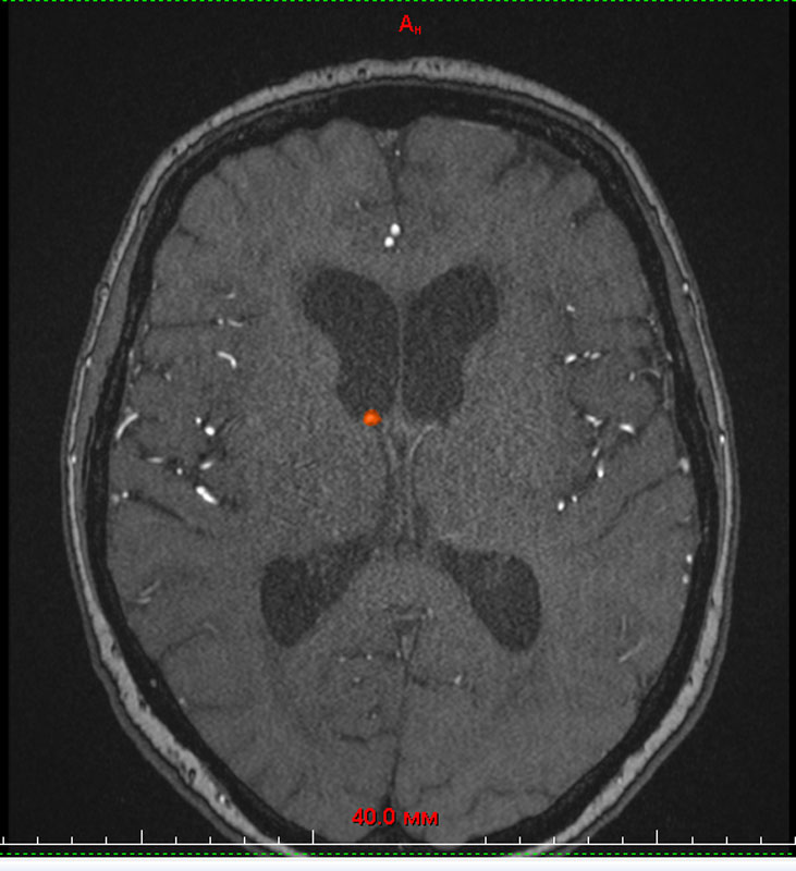 Левая гемисфера головного мозга. Венозная ангиома правой гемисферы мозжечка. Левая гемисфера мозжечка. Очаг в левой гемисфере. Венозная ангиома в базальных ядрах слева.
