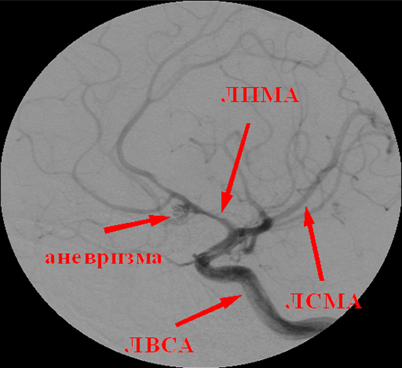 Сегмент а1 пма. Церебральный вазоспазм. Вазоспазм сосудов головного мозга. Вазоспазм сосудов головного мозга на УЗИ.