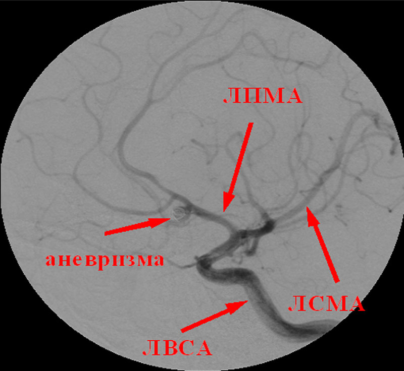 Лекарство спазма сосудов мозга. Ангиоспазм сосудов головного мозга. Спазм артерий головного мозга. Ангиоспазм в средней мозговой артерии. Периферический ангиоспазм.