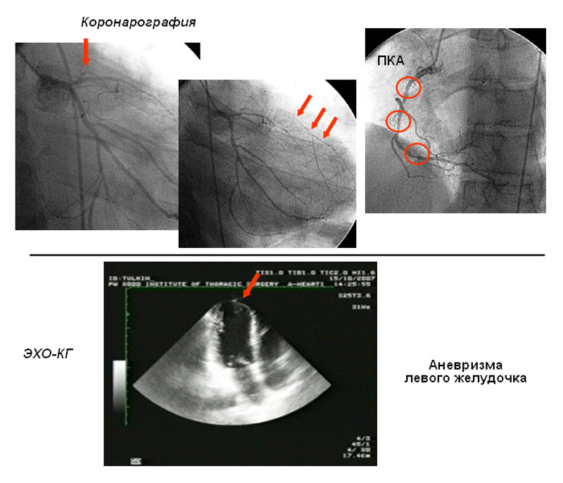 Эхо левого желудочка. Аневризма верхушки левого желудочка на Эхо. Аневризма верхушки лж ЭХОКГ. Аневризма верхушки сердца ЭХОКГ.