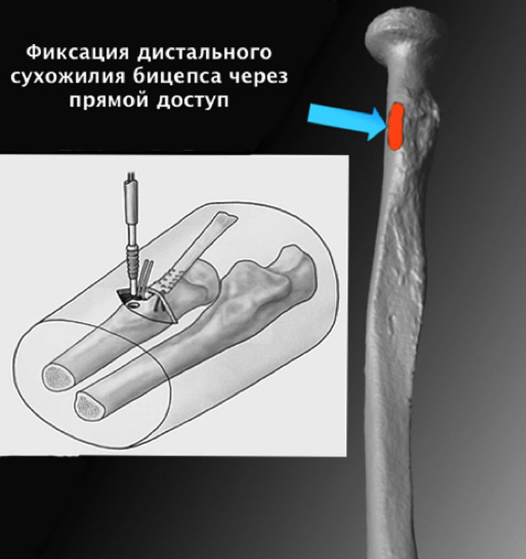 Дистальный разрыв