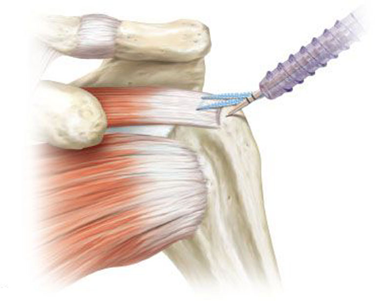 Разрыв надостного сухожилия плечевого сустава лечение. Артроскопический шов надостной мышцы. Разрыв надостной мышцы плечевого сустава. Разрыв сухожилия надостной мышцы. Отрыв сухожилия надостной мышцы плеча.