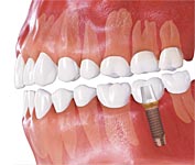 Имплантация при потере одного зуба
