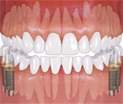 Имплантация при потере нескольких зубов