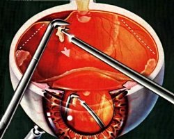 Технология щадящей витреоретинальной хирургии наиболее тяжелых форм диабета глаза 