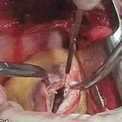 Рассечение аневризматического мешка и вскрытие полости левого желудочка