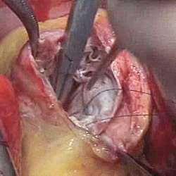 Формирование полости левого желудочка путем наложения кисетного шва