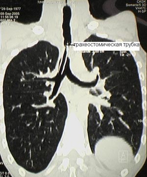 Компьютерная томография больного со стенозом трахеи 