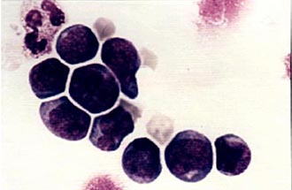 Стволовые клетки, несущие маркер CD34, внешне напоминают малые и средние лимфоциты