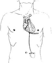 Подшитый к сердцу миокардиальный электрод и постоянный электрокардиостимулятор, размещенный под сухожильным влагалищем прямой мышцы живота.