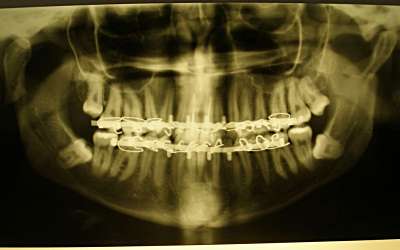Остеосинтез мыщелковых отростков нижней челюсти при двустороннем переломе со смещением