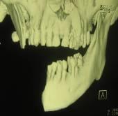 КТ с трёхмерным изображением дефекта нижней челюсти