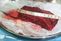 Полнослойный костно-мышечный трансплантат с сосудистой ножкой