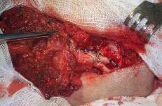 Костно-мышечный аутотрансплантат фиксирован к фрагментам нижней челюсти