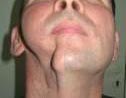 Внешний вид пациента до восстановления дефекта нижней челюсти