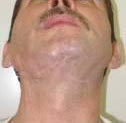 Внешний вид пациента через год после восстановления дефекта нижней челюсти