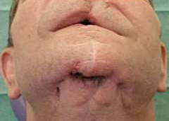 Дефект нижней и верхней челюсти после огнестрельного ранения