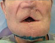 Восстановление дефекта нижней челюсти с использованием аутотрансплантата на микрососудистых анастомозах