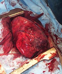 Хирургическое лечение гигантских опухолей грудной клетки