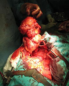 Хирургическое лечение гигантских опухолей грудной клетки