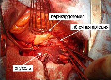 Сочетанная пневмонэктомия и адреналэктомия из одного доступа по поводу рака левого легкого с метастатическим поражением надпочечника