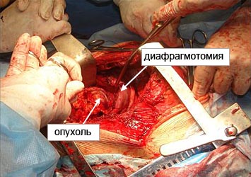 Сочетанная пневмонэктомия и адреналэктомия из одного доступа по поводу рака левого легкого с метастатическим поражением надпочечника