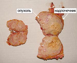Сочетанная пневмонэктомия и адреналэктомия из одного доступа по поводу рака левого легкого с метастатическим поражением надпочечника
