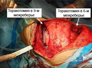Сочетанная пневмонэктомия и адреналэктомия из одного доступа по поводу рака левого легкого с метастатическим поражением надпочечника