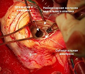 Ревизия корня аорты и аортального клапана
