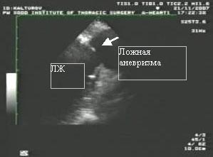 ЭхоКГ: определяется сообщение полости левого желудочка (ЛЖ) с полостью аневризмы