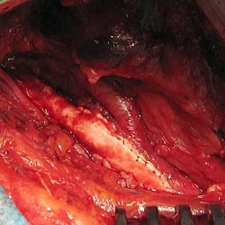 Выполнена классическая каротидная эндартерэктомия, пластика общей и внутренней сонных артерий синтетической заплатой Goretex