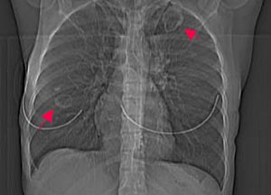 Рентгенограмма органов грудной клетки
