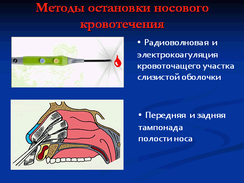 Передняя и задняя тампонада носа. Методы остановки носового кровотечения ЛОР. Способы остановки носового кровотечения. Носовые кровотечения оториноларингология.