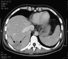 Tumor of the right lobe of the liver, 4.5 cm in diameter (two arrows).