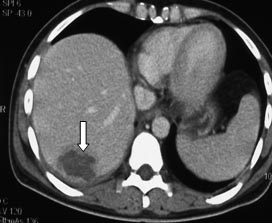 After performing ultrasound ablation (own observation), the ablation volume is 93% (arrow).