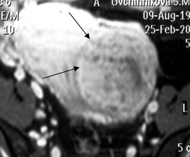 Myomatous node along the front wall, dimensions 75x83mm (two arrows).